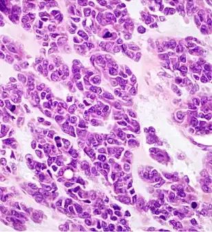 Эпителиоидноклеточный тип ГИСО [12]