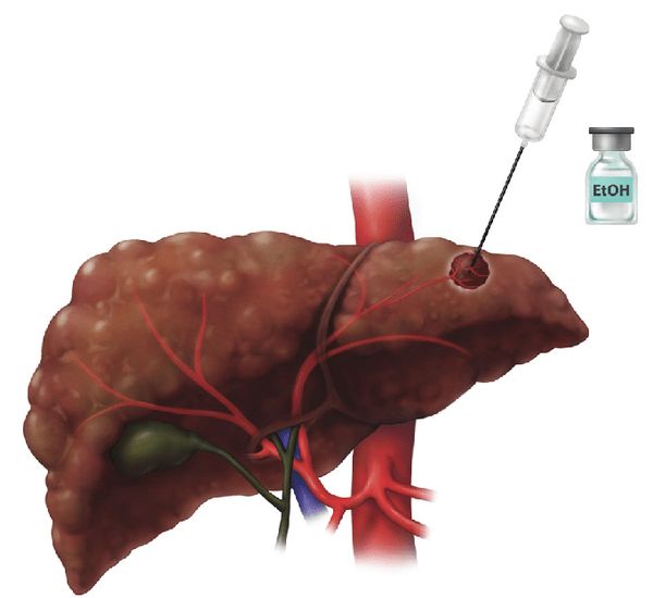 Этаноловая абляция. В опухоль печени вводят чистый этанол