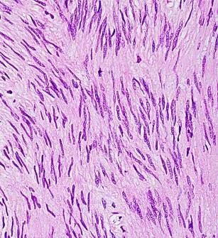 Веретеноклеточный тип ГИСО [12]