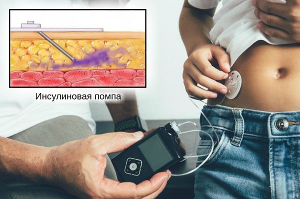 Непрерывная подкожная инфузия инсулина 