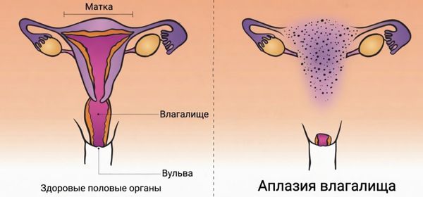 Аплазия влагалища