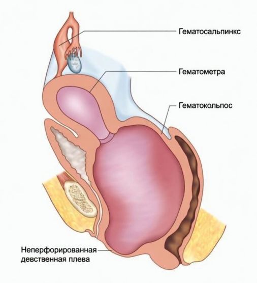 Гематокольпос и другие патологии, связанные с нарушением оттока менструальной крови