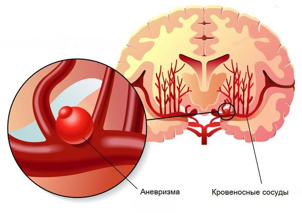 anevrizma golovnogo mozga s