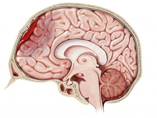 gematoma golovnogo mozga s