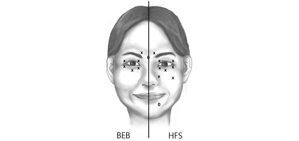 Схема мест инъекций для лечения блефароспазма (BEB) и гемифациального спазма (HFS)