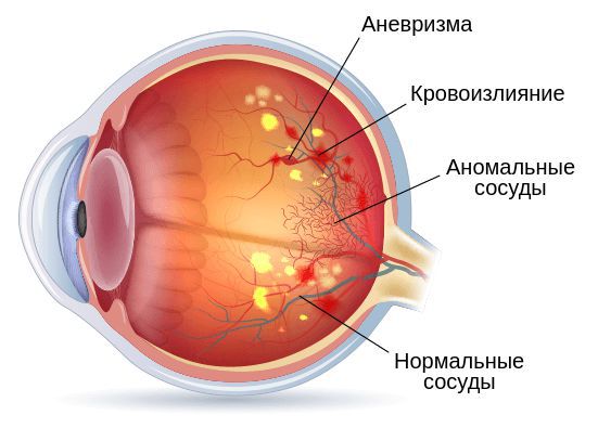 Чем лечить при кровоизлиянии в глаз