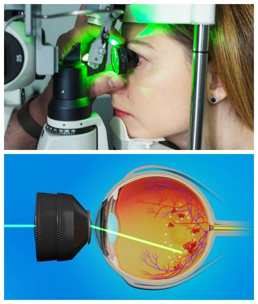 Лазерная фотокоагуляция сетчатки
