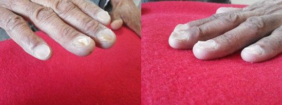 Койлонихия [44]