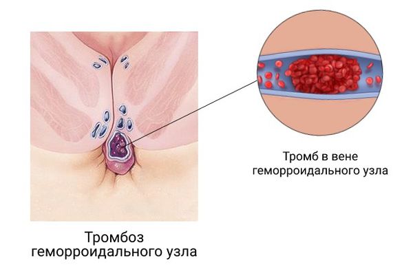 Тромб в геморроидальном узле