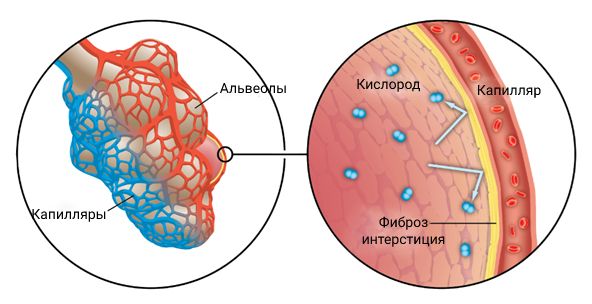 Фиброз интерстиция