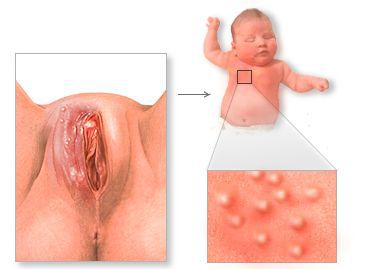 gerpes neonatalnyy s
