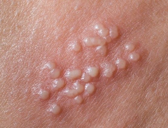 Пузырьки при герпесе [11]