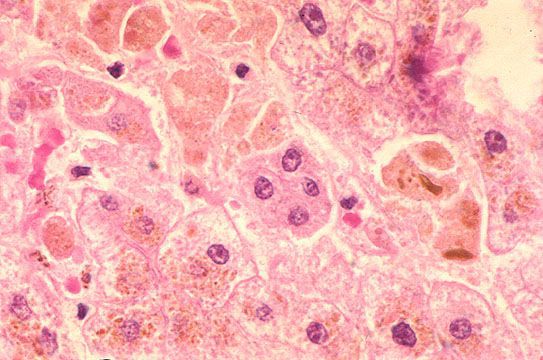 Изменение клеток печени при гепатите А