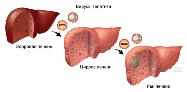 Рак и цирроз печени