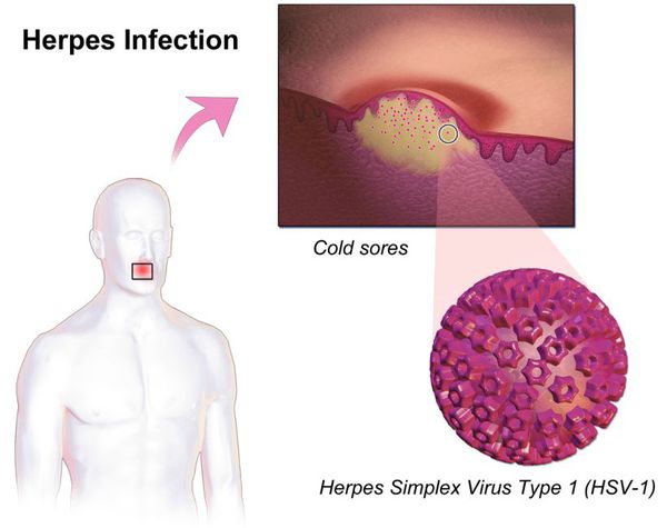 Массивное размножение вируса простого герпеса I типа в клетках эпителия