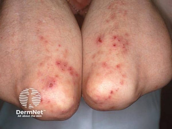 Герпетиформный дерматит Дюринга [12]