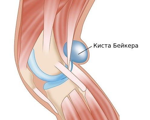 ганглионарная киста коленного сустава мрт. синовиальная киста коленного сустава. ганглий лучезапястного сустава. киста коленного сустава на узи. гигрома лучезапястного сустава.