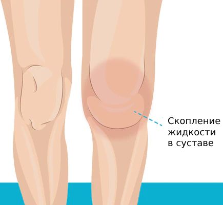 Лечение воспаления синовиальной оболочки коленного сустава