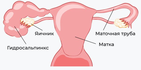 Гидросальпинкс