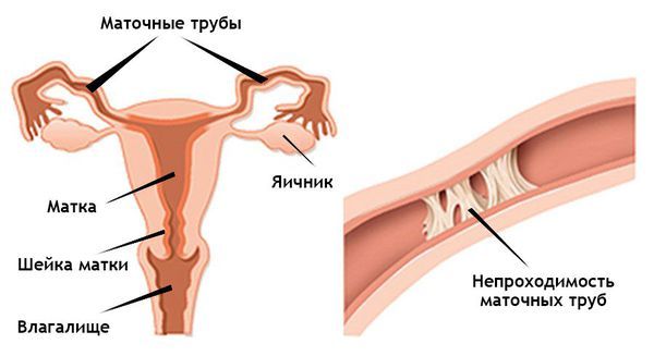 Непроходимость маточной трубы
