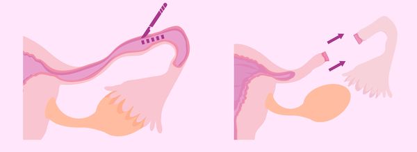 Сальпингостомия и сальпингэктомия