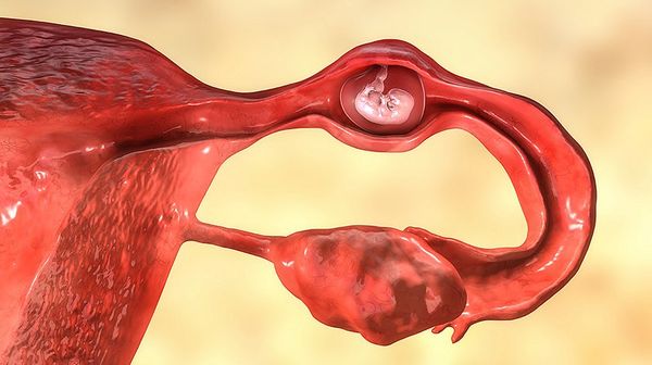 Трубная беременность