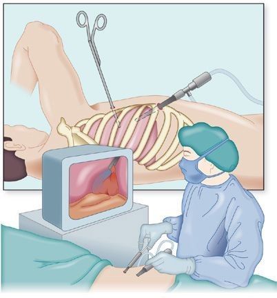 Видеоторакоскопия [20]