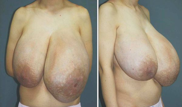 Гигантомастия Гигантомастия