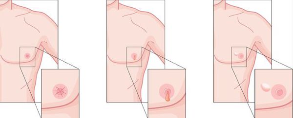 Признаки рака молочной железы