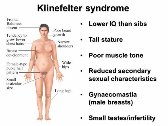 Признаки синдрома Клайнфелтера