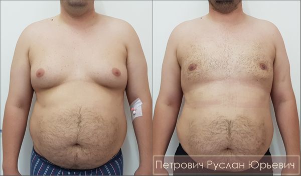 Пересадка жира: фотографии до и после