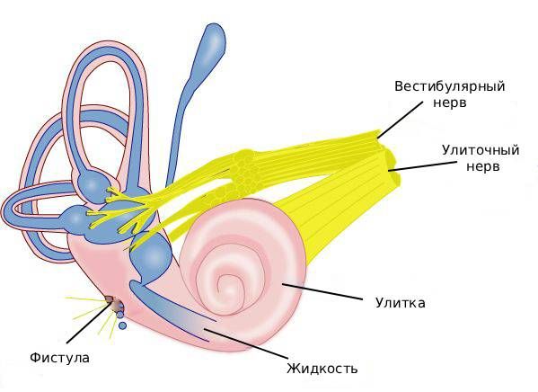 Перилимфатическая фистула
