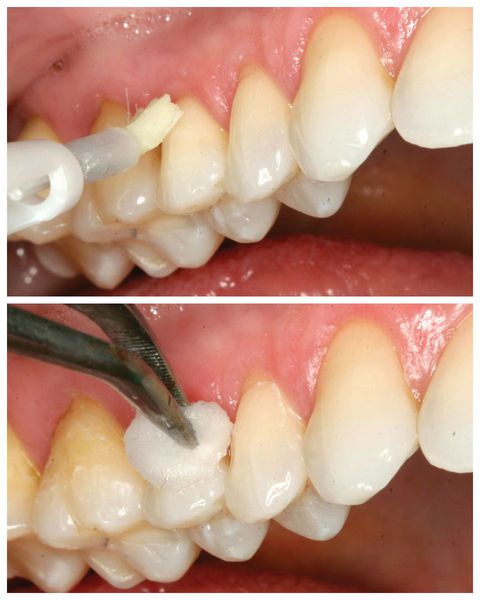 Нанесение стоматологического лака и геля