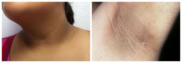 Чёрный акантоз [20]