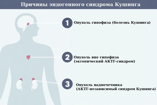 Причины эндогенного синдрома Кушинга Причины эндогенного синдрома Кушинга