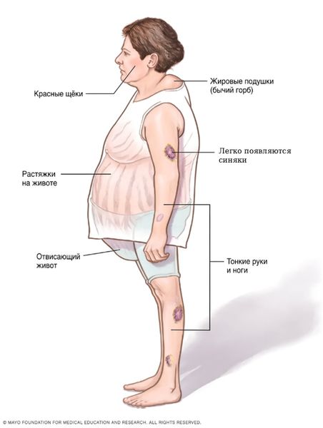 Выраженные внешние проявления синдрома Кушинга [16]