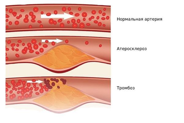 Атеросклероз и тромбоз