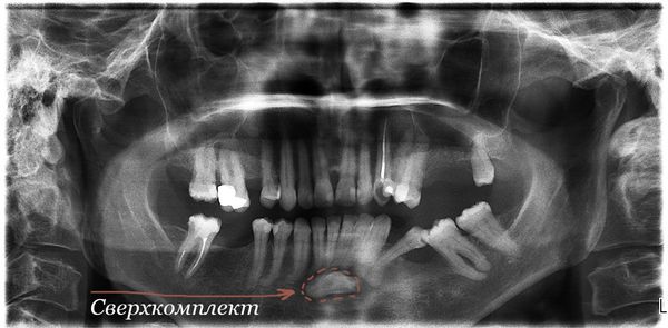 Сверхкомплектный зуб на ортопантомограмме