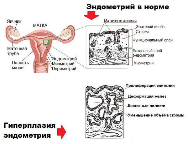 Эндометрий в норме и при гиперплазии