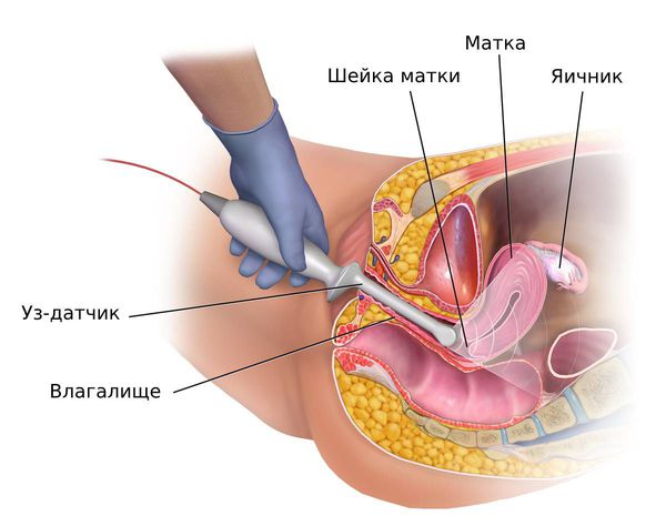 transvaginalnoe ultrazvukovoe issledovanie s