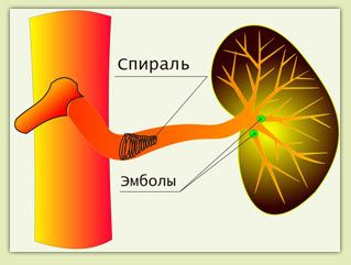 Эмболизация селезёночной артерии