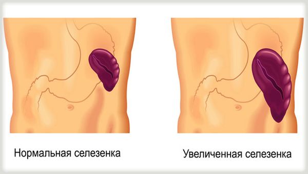 Гиперспленизм