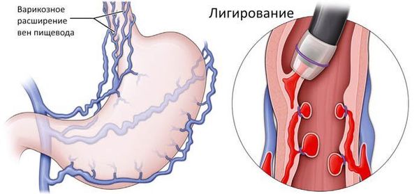 Лигирование сосудов пищевода