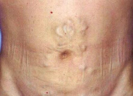 Расширение сосудов пищевода по типу головы медузы [18]