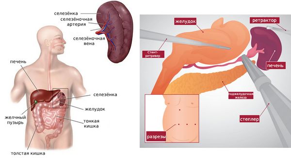 Спленэктомия