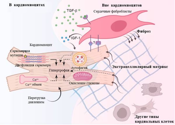 Общая модель патогенеза ГКМП [5]