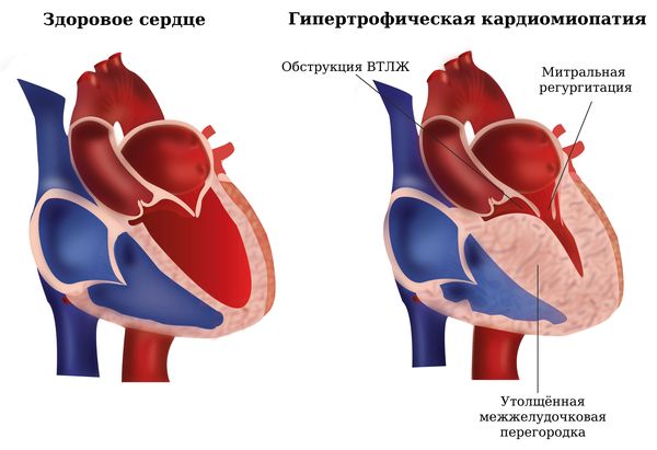 Обструкция ВТЛЖ и митральная регургитация при ГКМП