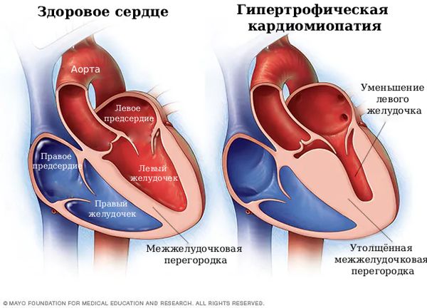 Здоровое сердце и гипертрофическая кардиомиопатия [11]