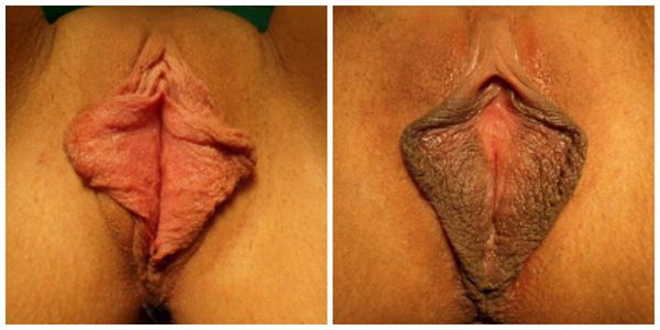 Гипертрофия малых половых губ. Пигментация.