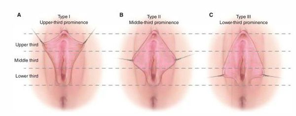 Классификация морфологии малых половых губ